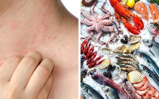 Dấu hiệu dị ứng thực phẩm khi mang thai