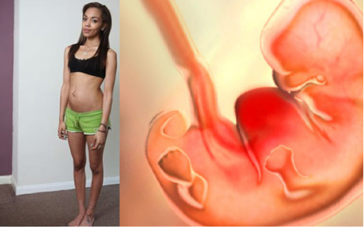 Mẹ thiếu chất là nguyên nhân gây túi ối nhỏ