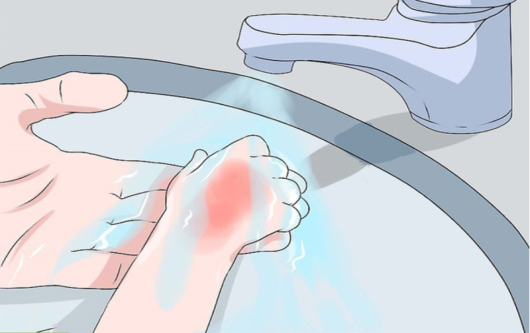 Bỏng ở trẻ em và cách xử trí