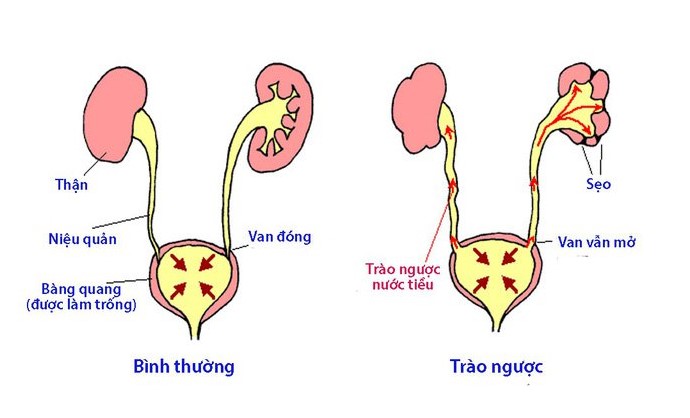 Giãn bể thận hai bên 