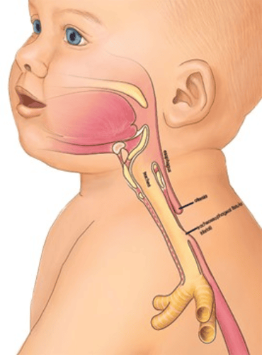 Teo thực quản bẩm sinh