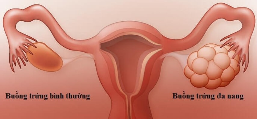 buồng trứng đa nang,