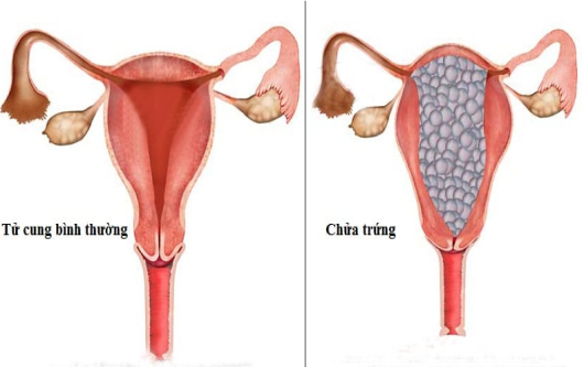 Sự nguy hiểm của chửa trứng đối với sức khỏe phụ nữ