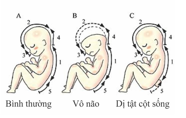 dị tật ống thần kinh