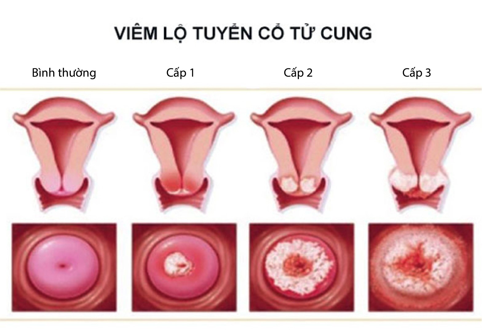 Viêm lộ tuyến cổ tử cung khi mang thai