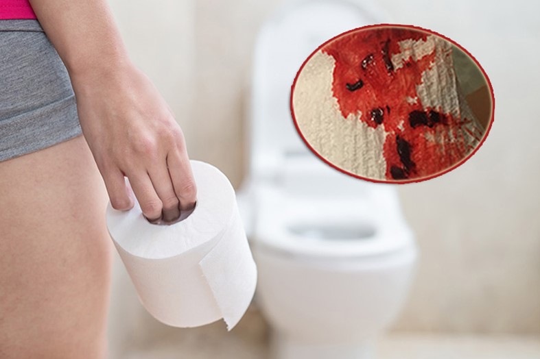 Bệnh trĩ sau sinh đi đại tiện ra máu