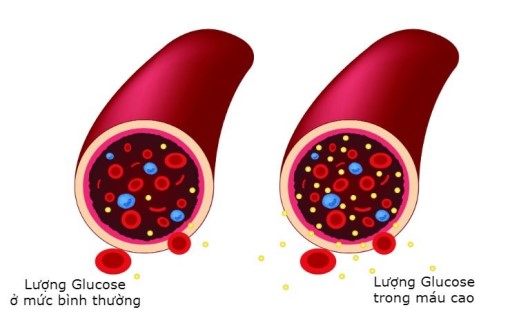 Nghiệm pháp đường huyết sau sinh