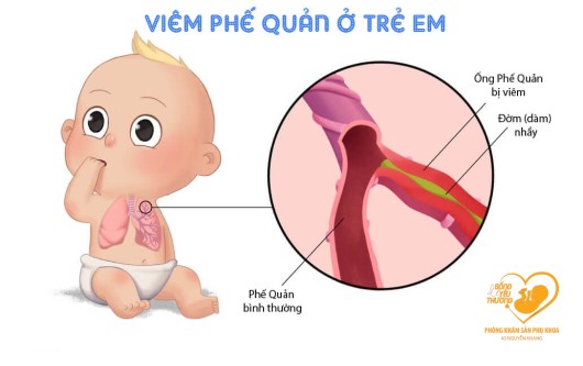 Bệnh viêm phế quản phổi ở trẻ em