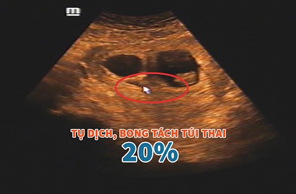 Bóc tách túi thai