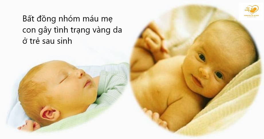 bất đồng nhóm máu mẹ con