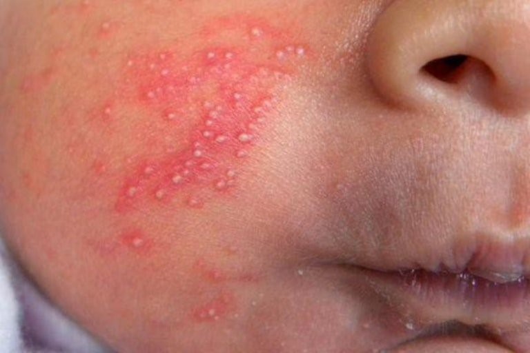 bệnh lý thường gặp ở trẻ 