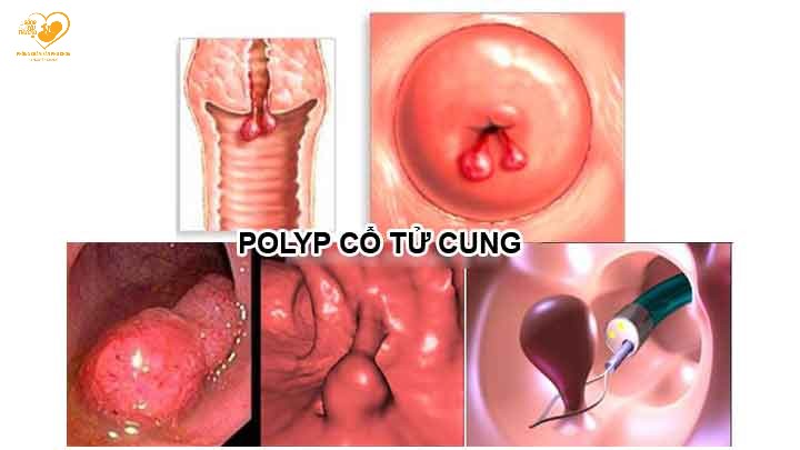 bệnh phụ khoa