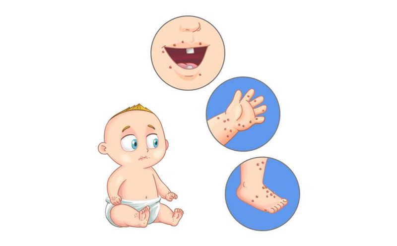 bệnh tay chân miệng là gì
