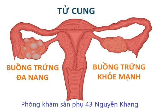 buồng trứng đa nang