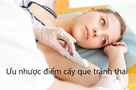 cấy que tránh thai