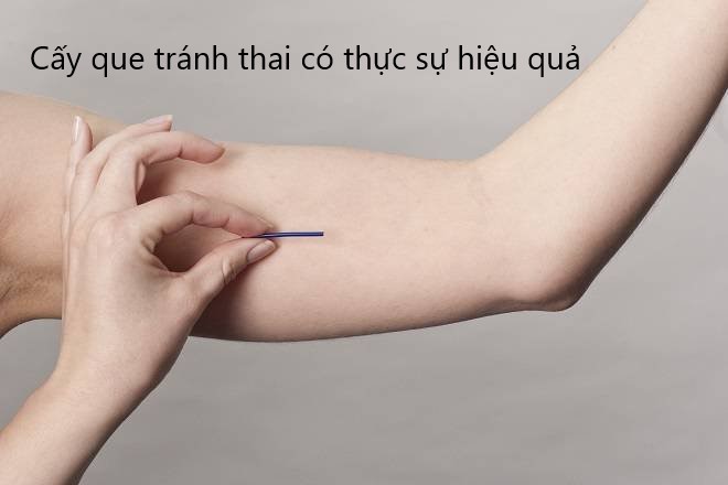 cấy que tránh thai