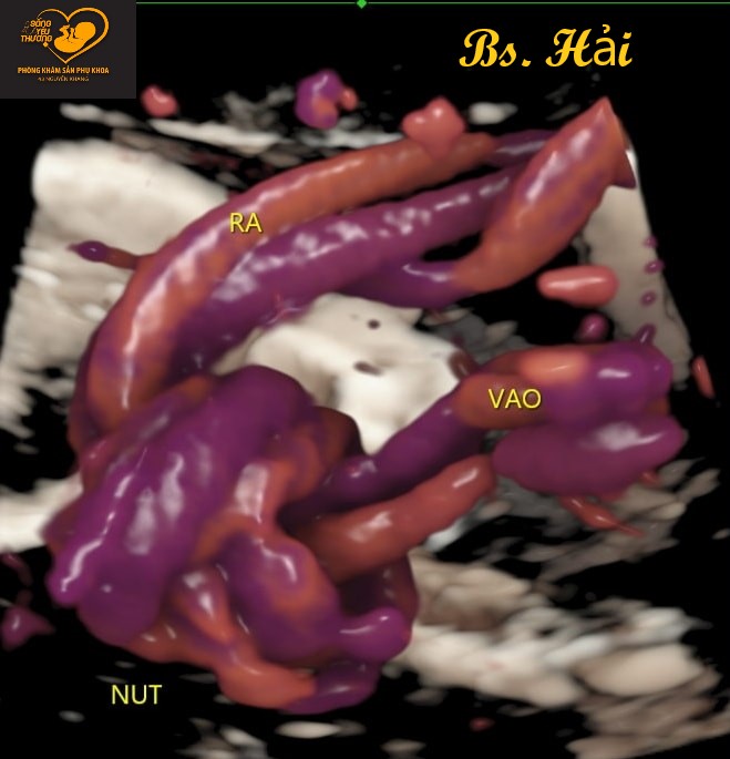 dây rốn thắt nút