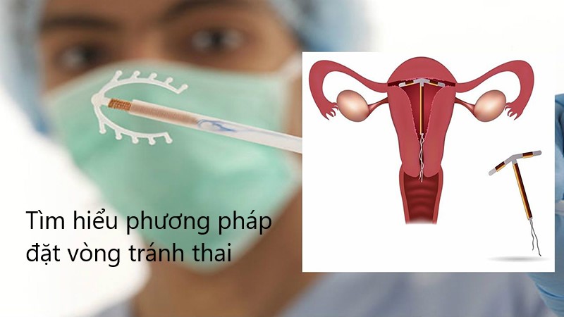 sau sinh mổ không nên đặt vòng