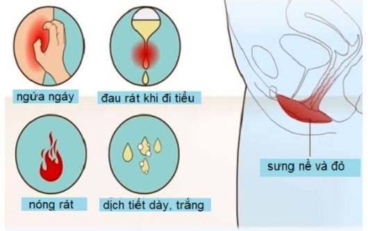 viêm âm đạo do nấm candida