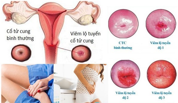 viêm lộ tuyến cổ tử cung cấp độ 1