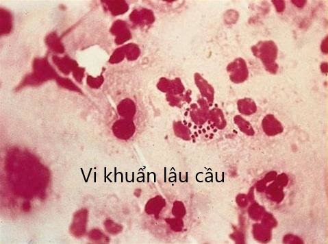 viêm phụ khoa