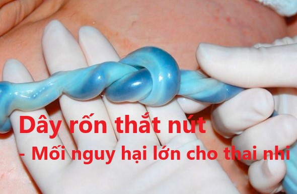 dây rốn thắt nút
