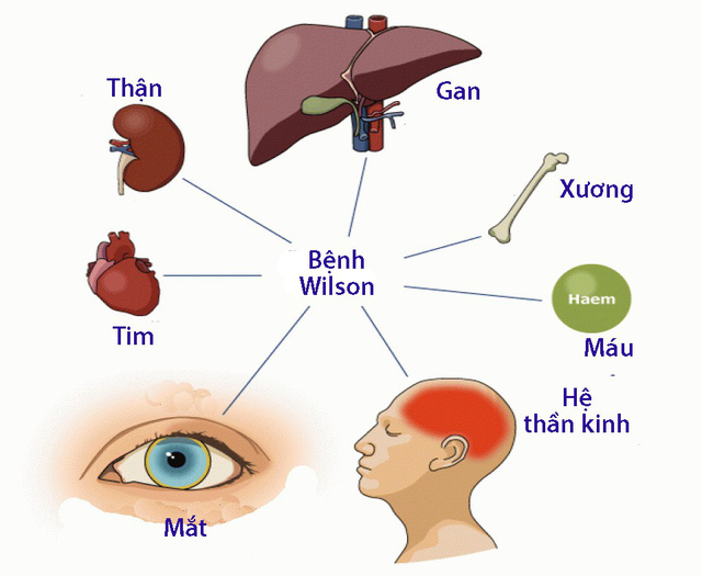 triệu chứng bệnh wilson