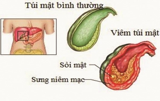 sỏi túi mật khi mang thai