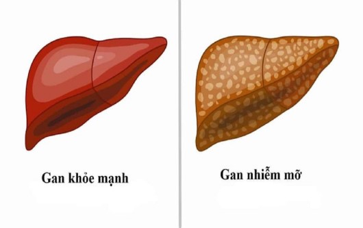 gan nhiễm mỡ khi mang thai