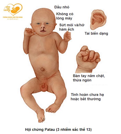hội chứng patau