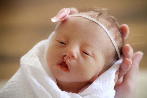 5 hội chứng liên quan đến bất thường nhiễm sắc thể