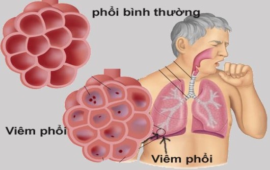 viêm phổi