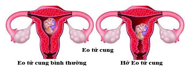 hở eo tử cung