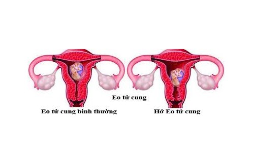 hở eo tử cung