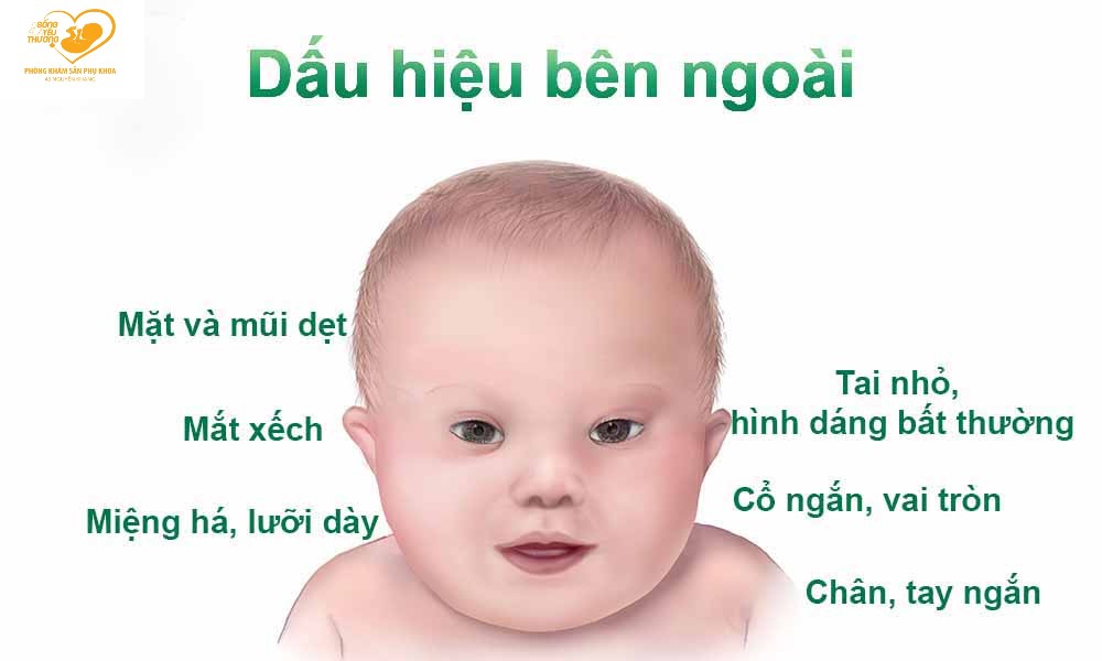 hội chứng down
