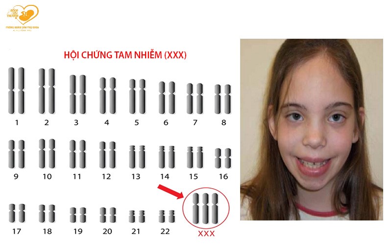 hội chứng siêu nữ