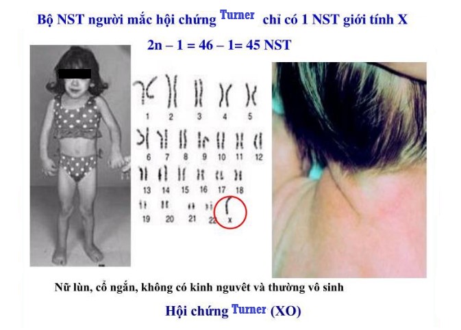 rối loạn nhiễm sắc thể