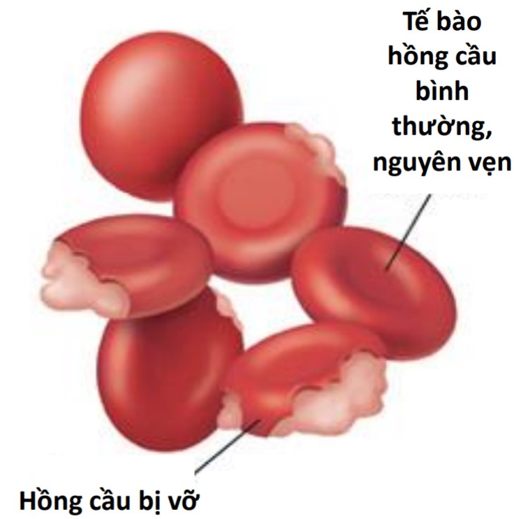 lấy máu gót chân