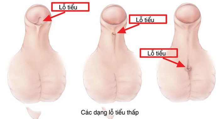 lỗ tiểu đóng thấp