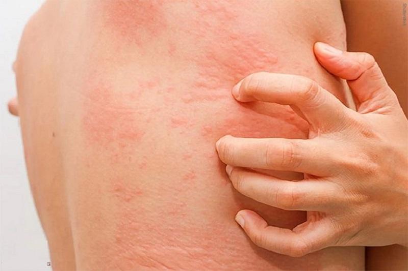 Đặc điểm của dị ứng thuốc và cách phòng tránh