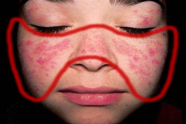 Các biểu hiện lâm sàng của dị ứng thuốc phần 3