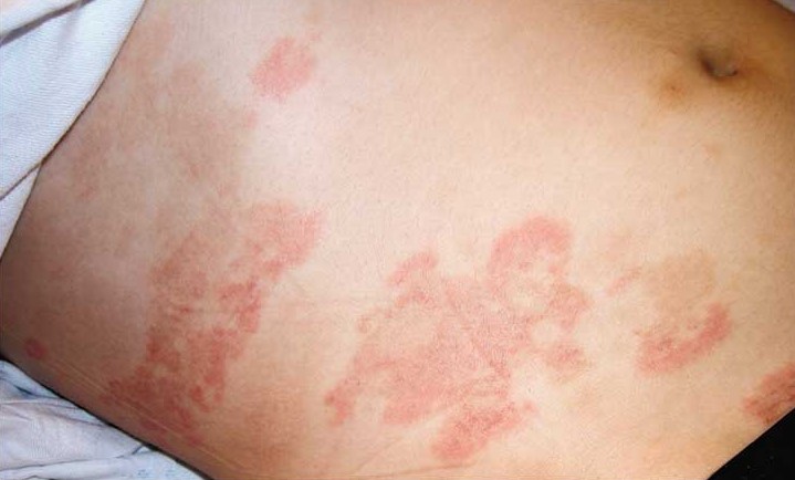 bệnh lupus ban đỏ khi mang thai