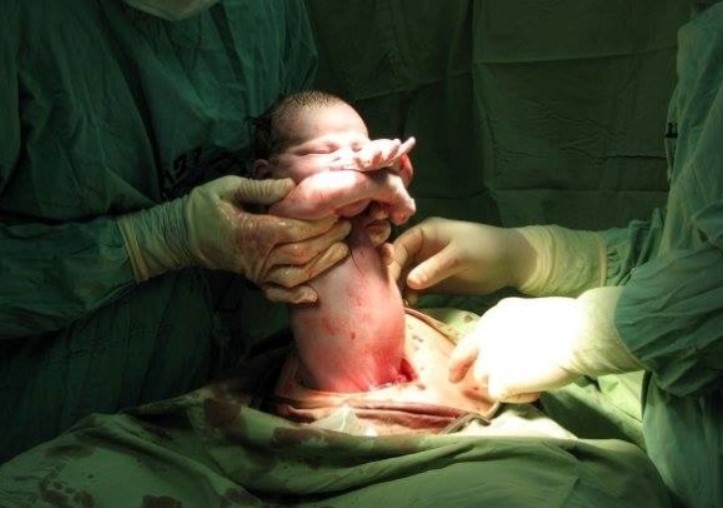 thai nhi ngôi vai phải sinh mổ