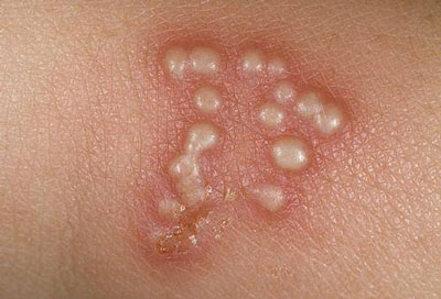 nhiễm virus hpv khi mang thai