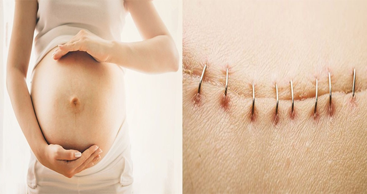 nhiễm trùng vết mổ
