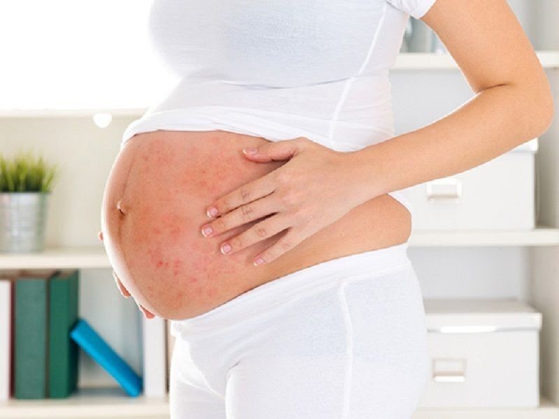 Nổi mề đay khi mang thai - Phòng khám 43 Nguyễn Khang