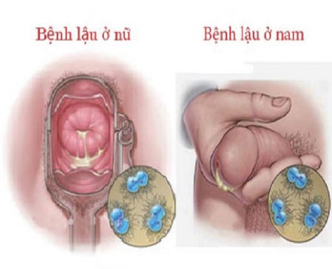 Bệnh lây truyền qua đường tình dục - bệnh lậu