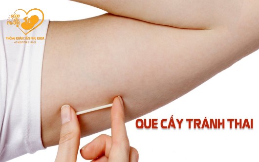 Cấy qua tránh thai - biện pháp tránh thai mới hiện đại an toàn