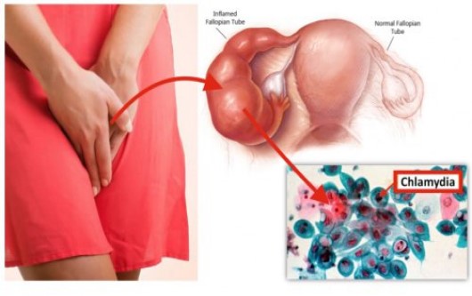 Nhiễm chlamydia có dấu hiệu gì?