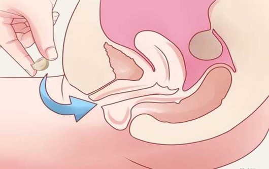 Đặt thuốc phụ khoa bao lâu thì ra bã